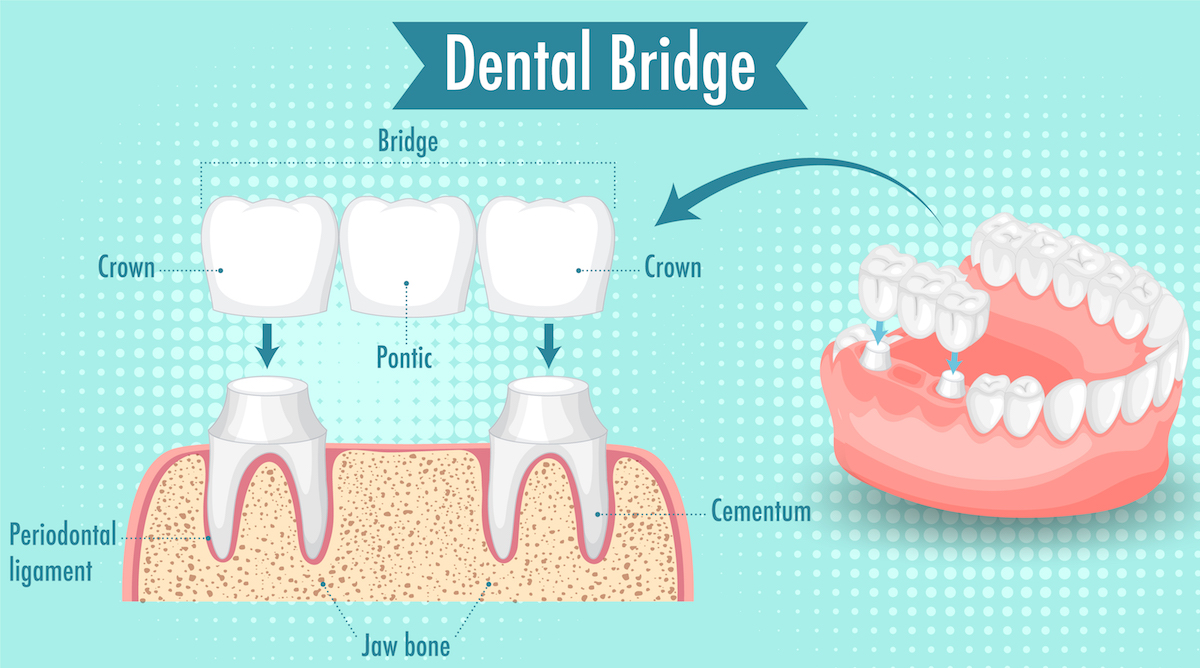 Infographic of human in dental bridge